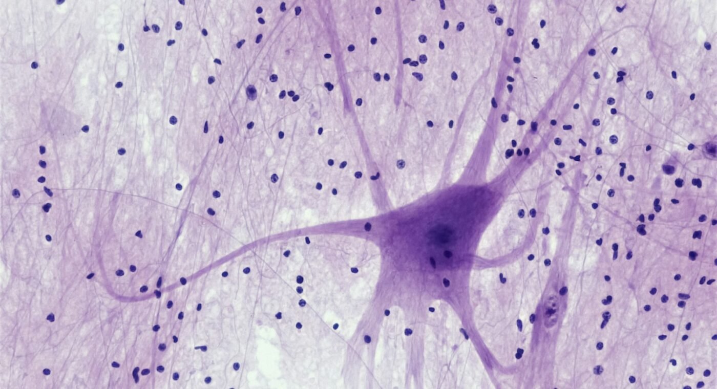 Nanobodies discovered in Lisbon halt the clumping of a protein linked to Alzheimer's